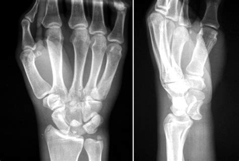 Colles’ Fracture - Pictures, Treatment, Healing Time, Surgery, Symptoms ...