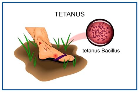 Tetanus: Causes, Symptoms & Treatment