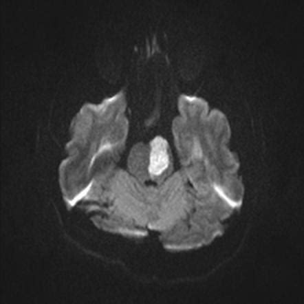 Paramedian Pontine Infarct