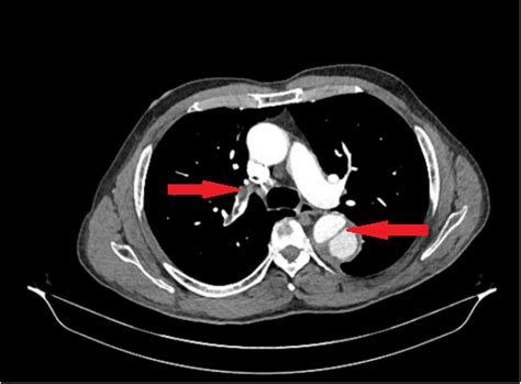 Aortic Dissection CT Scan