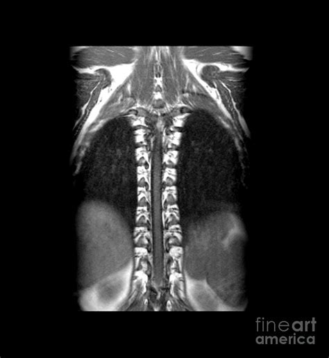 Normal Mri Of Thoracic Spinal Cord Photograph by Medical Body Scans