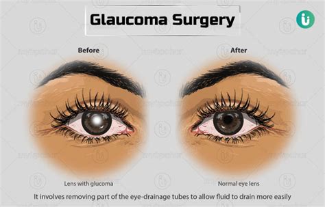 Glaucoma surgery: Procedure, Purpose, Results, Cost, Price