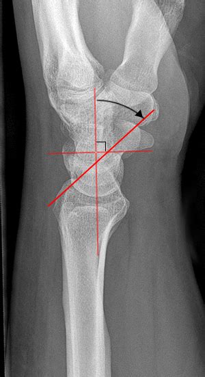 Scapholunate Dislocation