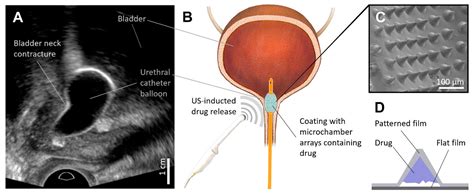 Pharmaceutics | Free Full-Text | Ultrasound-Triggerable Coatings for ...