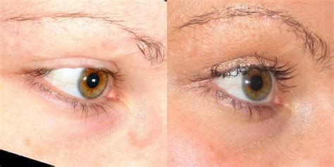 Eyelash Transplant Results - Bauman Medical Group