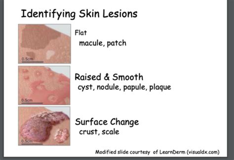 Macule Vs Papule