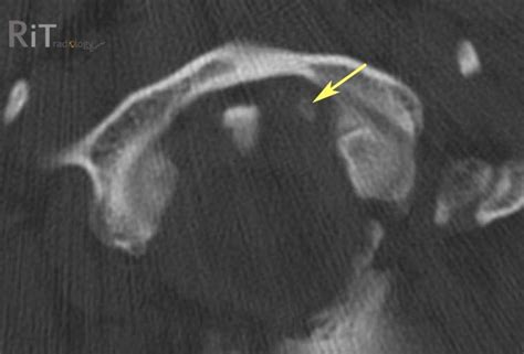 RiT radiology: Occipital Condylar Fracture