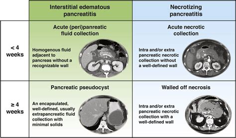 Current Concepts in Severe Acute and Necrotizing Pancreatitis: An ...