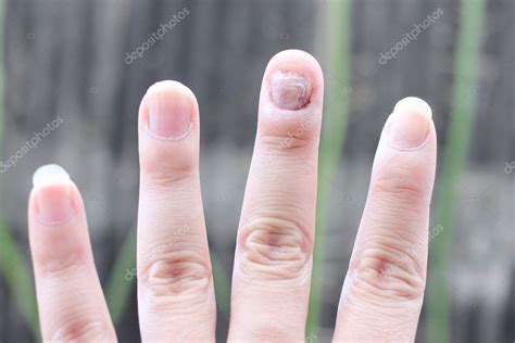 Wood splinter in finger infection. Wood Splinter in Finger: Infection ...