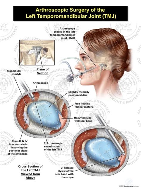 Female Arthroscopic Surgery of the Left Temporomandibular Joint (TMJ)