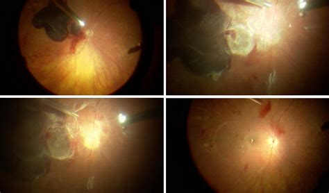 Vitrectomy for Diabetic Retinopathy: Think Early, Not Late - Retina Today