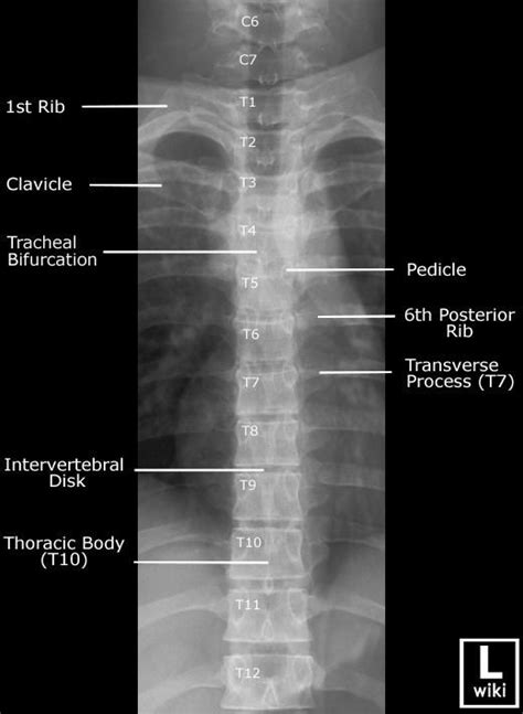 Thoracic Spine Radiographic Anatomy | Radiology student, Radiology tech ...