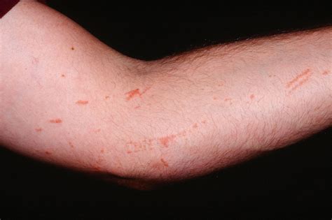 Poison Ivy Rash - Causes, How To Identify Poison Ivy Rash & Treatment