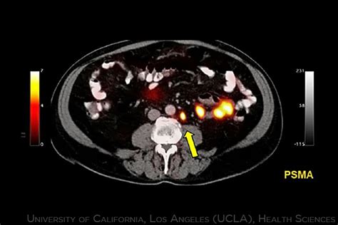 PSMA PET/CT Better Detects Prostate Cancer Spread | MedPage Today