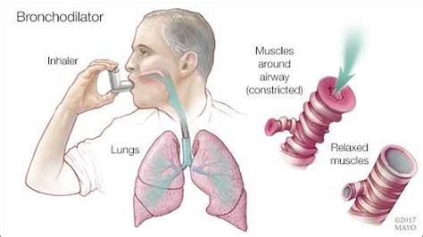 Mayo Clinic Q and A: COPD treatment with two types of bronchodilators ...