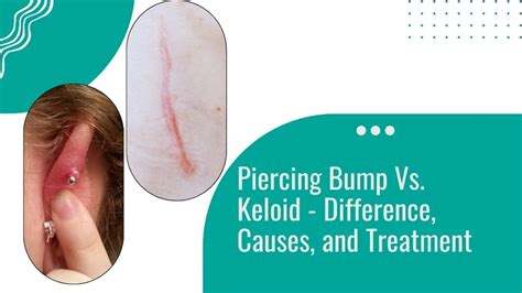 Piercing bump vs. keloid