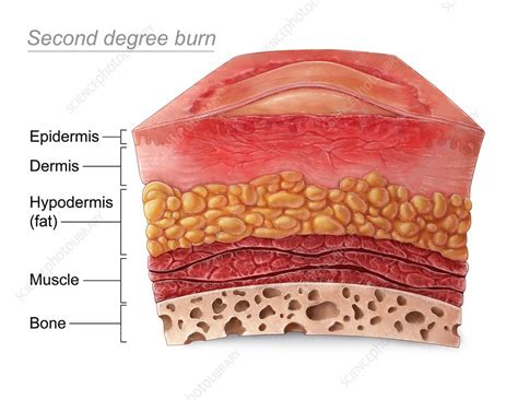 Second Degree Burn - Stock Image - C030/5964 - Science Photo Library