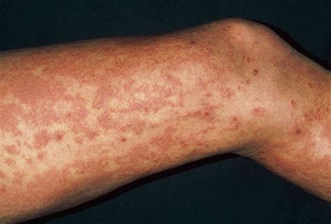 Pictures of Hives (Urticaria) of Different Types