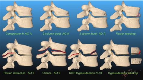 Spine Fracture Classification- 2019 | UW Emergency Radiology