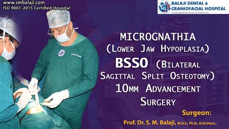 Micrognathia (Lower Jaw Hypoplasia) Bilateral Sagittal Split Osteotomy