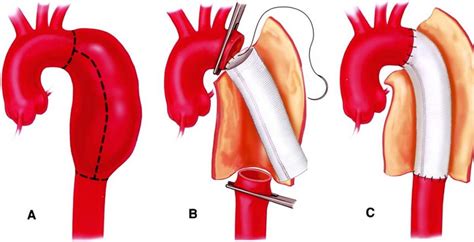 Aortic Aneurysm Repair in Ranchi,Aortic Aneurysm Surgery in Ranchi