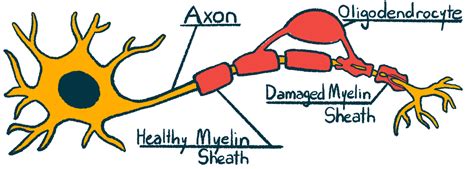 Does the Myelin Sheath Play a Role in MS?