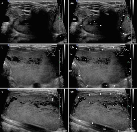 Thyroid Goiter Ultrasound