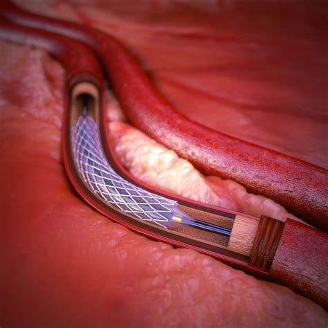 coronary artery stent 3d max