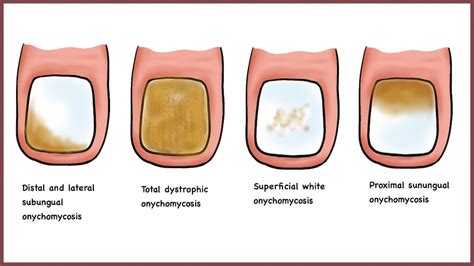 Total Dystrophic Onychomycosis