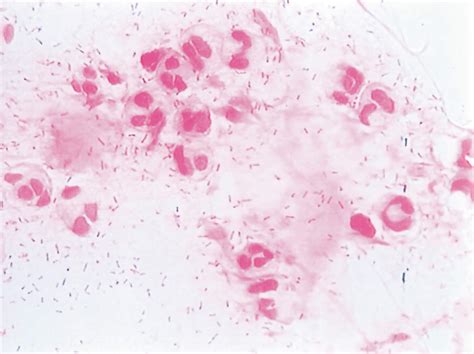 Community Eye Health Journal » Conjunctivitis: diagnosis and management