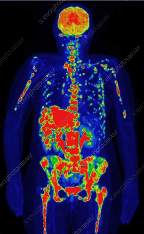 Metastatic breast cancer, PET scan - Stock Image - C055/8594 - Science ...