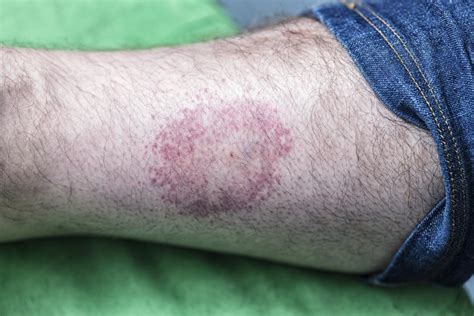 Lyme disease rash: Symptoms, stages, and identification