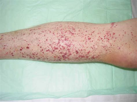 Thrombocytopenia - Causes, Signs, Symptoms, Diagnosis, Treatment