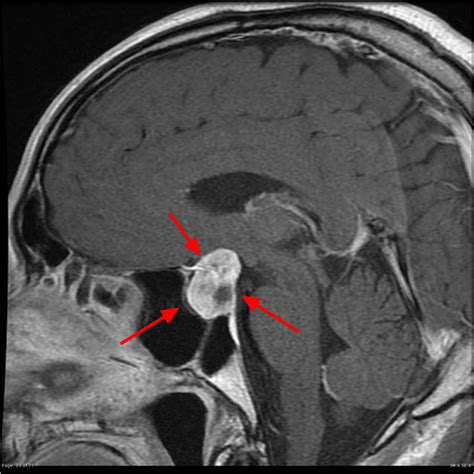 Pituitary Tumor - Signs, Symptoms, Diagnosis, MRI, Surgery & Treatment