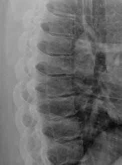 Thoracic Spine X-Ray: Diagnosing Spinal Conditions