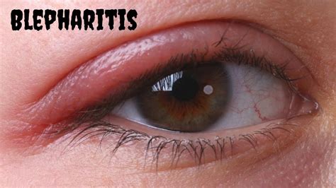 blepharitis treatment at home | 5 Home Remedies For Blepharitis ...