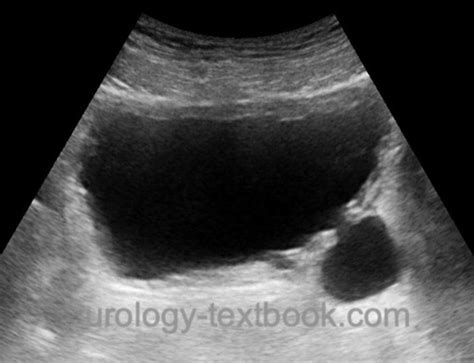 Bladder Diverticulum: Etiology, Diagnosis and Treatment