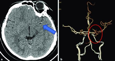 a CT brain showing hyperdense MCA sign (blue arrow). b CT brain ...