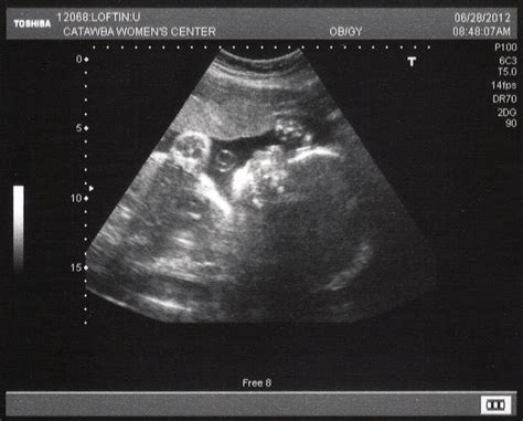 Ultrasound (30 weeks) – Philip, Leslie & Kayli