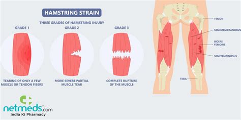 Hamstring Injury: Causes, Symptoms And Treatment