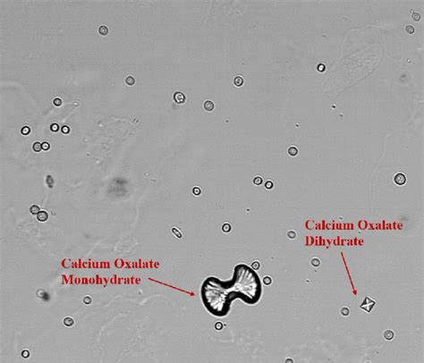 Microscopic display of calcium oxalate monohydrate and dihydrate ...