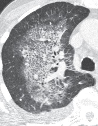 111 Diffuse Alveolar Hemorrhage | Radiology Key