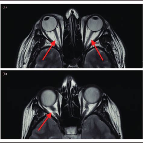 (a) Axial T1-weighted MRI demonstrates normal appearance of the optic ...