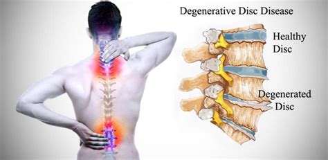 What Causes Sciatica to Flare Up? - Top 8 Triggers - 33rd Square