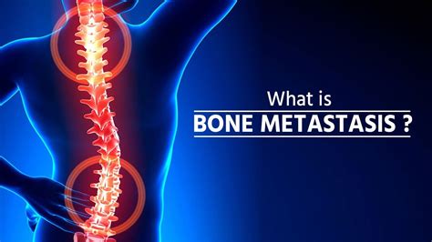 What is bone metastasis | Stage 4 Cancer | Bone Metastasis | How Cancer ...