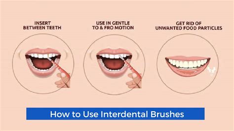 Ways to Use of Interdental Brushes Cause Gaps Effectively