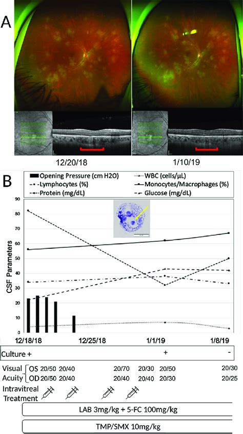 Timeline of opening pressure and CSF results, CSF culture, visual ...