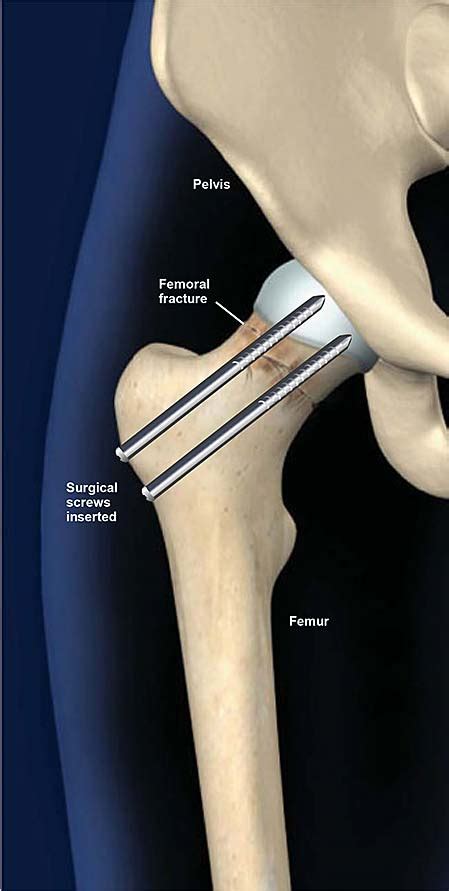 Fractured Femur Cast