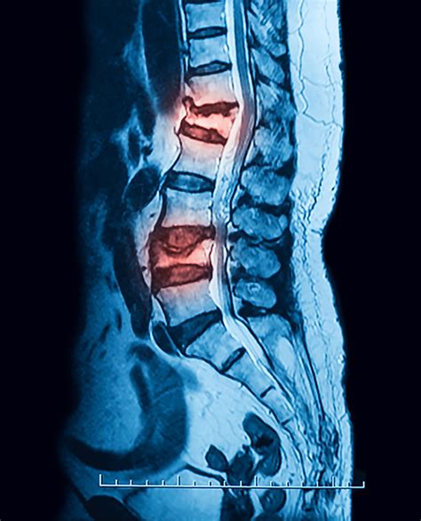 Vertebral Compression Fracture Treatment in NJ and NYC | Premier Brain ...