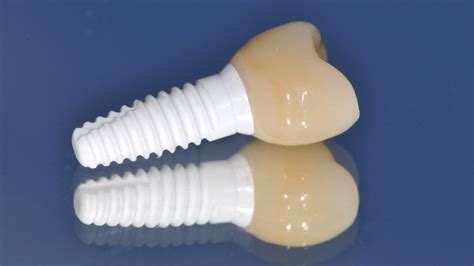 Ceramic dental implants: innovation in dentistry | Innovation News Network